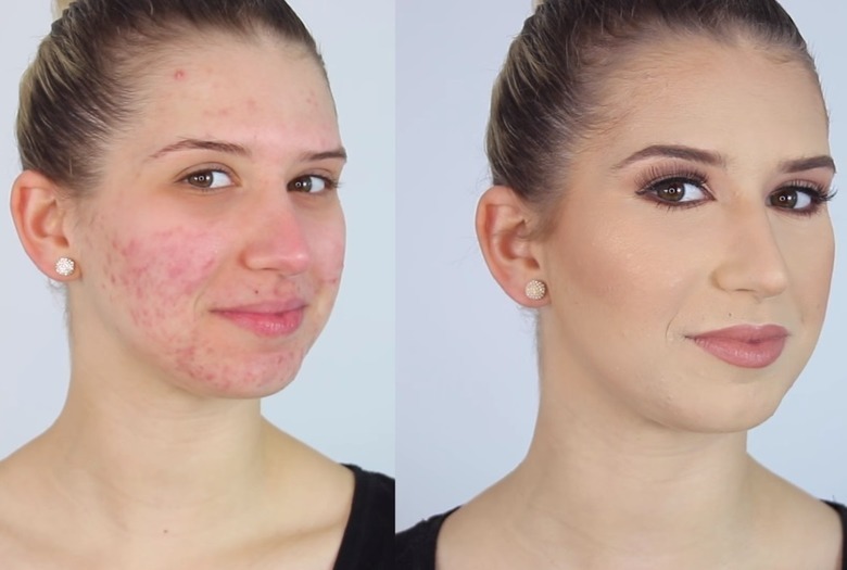 Sådan lægger du makeup, hvis du har akne